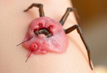 When to Seek Help Tarantula Bite
